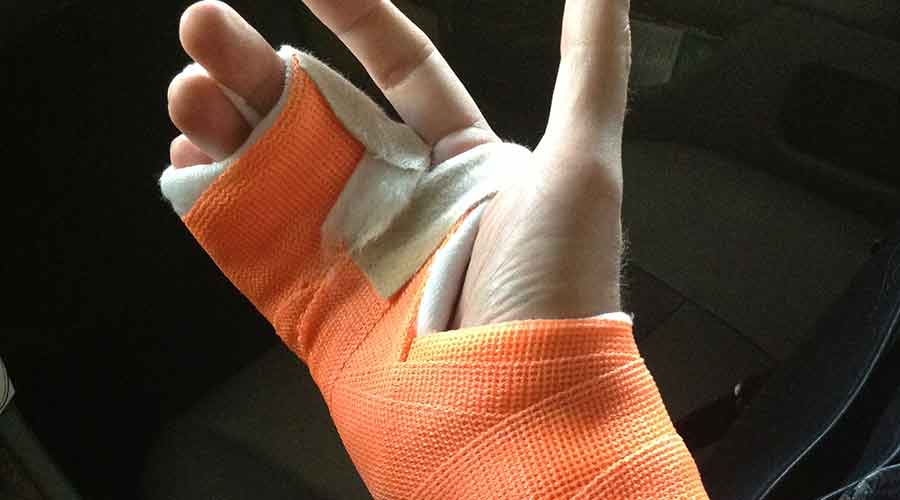 injured hand from re-closing breakers. By BCH Electrical Safety Consulting